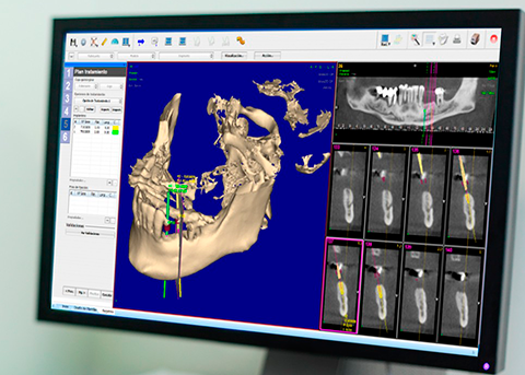 Planificacion de implantes dentales