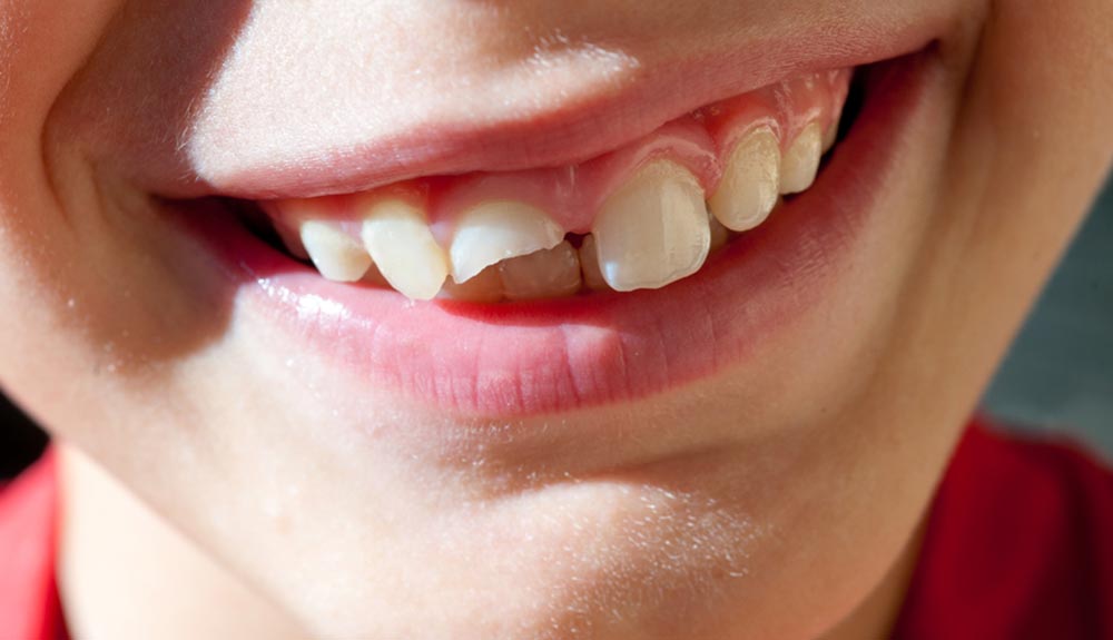 Niño con fractura dental