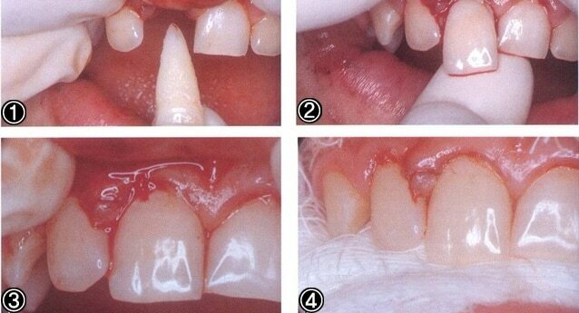 Reimplantación de un diente