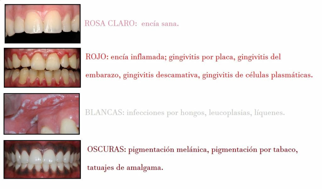 Distintos colores y aspectos de encías sanas y no sanas.